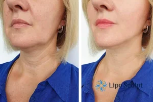 Double chin before and after Hi-Fu treatment 4 Book your double chin treatment Gosport today! We are here to help!