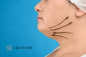 Double chin before and after Hi-Fu treatment 3 Boost your confidence with a Double chin treatment Gosport