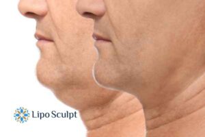 Double chin before and after Hi-Fu treatment 2 Double chin treatment Gosport from Lipo Sculpt - feel more confident today!