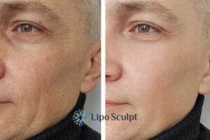 How to Fight Aging Symptoms 3 Fight Aging Symptoms Gosport With HIFU and Morpheus8 Today!