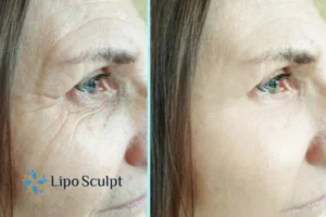 How to Fight Aging Symptoms 2 Do you want to Fight Aging Symptoms Gosport? Contact Lipo Sculpt today!