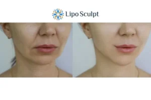 Explaining Total Skin Tightening Treatment And What It Can Do For You 2 Do you want to boost your self confidence? Give Morpheus8 Gosport a try today!