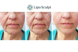 Explaining Total Skin Tightening Treatment And What It Can Do For You 3 Boost your confidence with Morpheus8 Gosport call our team today!