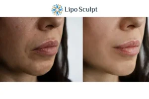 Explaining Total Skin Tightening Treatment And What It Can Do For You 4 Morpheus8 Gosport the best results - call our team today!
