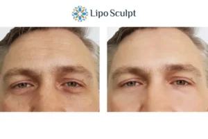 Explaining Total Skin Tightening Treatment And What It Can Do For You 6 Morpheus8 Gosport book in today to find out more!